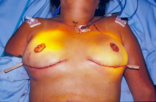 Mamoplastía Reductiva: Técnica Lalonde