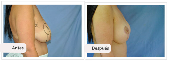 Mamoplastía con Cicatriz T Corta - Perfil y Frente