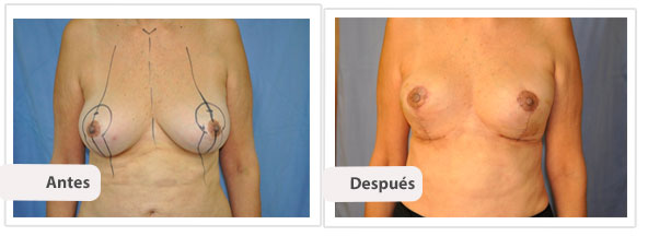 Mamoplastía Reductiva con Cicatriz T Corta: Caso 3