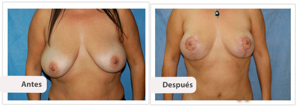 Mamoplastía Reductiva con Cicatriz T Corta: Caso 4