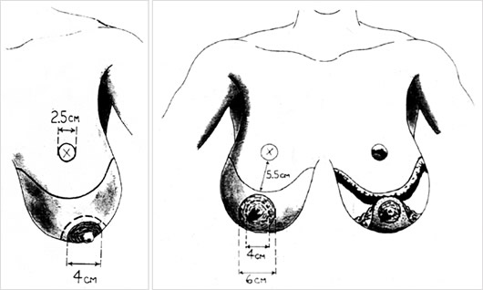 Mamoplastía sin Cicatriz Vertical