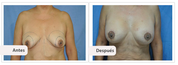 Mastopexia Periareolar con Implantes Perfil Caso 4 - frente