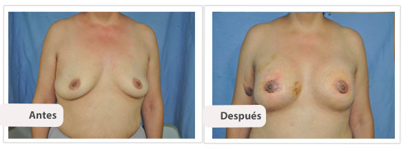 Mastopexia Periareolar con Implantes Perfil Caso 5 - frente