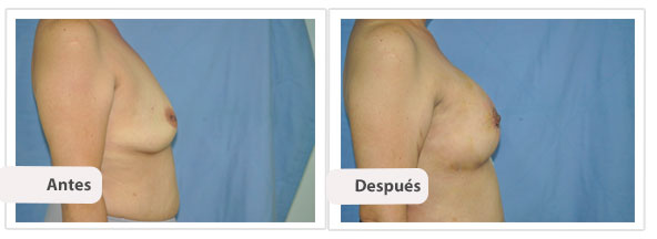 Mastopexia Periareolar con Implantes Perfil Caso 4 - frente