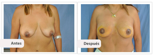 Mastopexia Periareolar con Implantes Perfil Caso 7 - frente