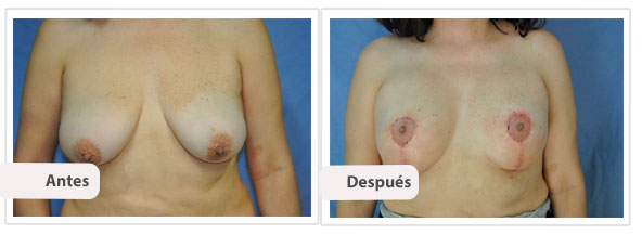 Mastopexia T Corta con Implantes: Caso 1