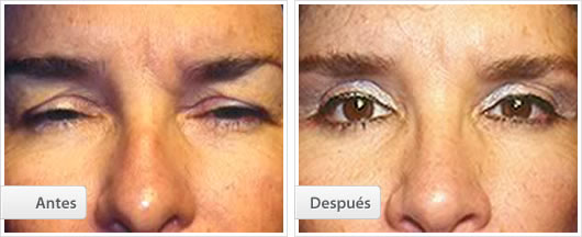 Blefaroplastia Superior