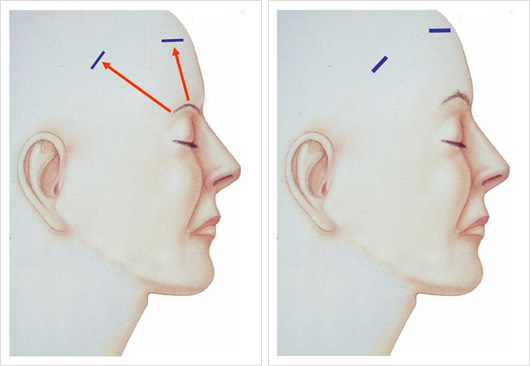 Levantamiento de Cejas Lateral