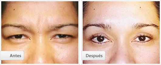 Cirugía Endoscópica Frontal