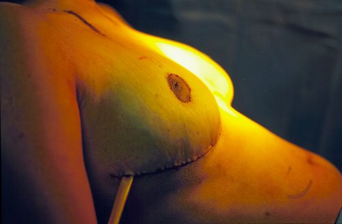 Técnica Lalonde Post Operatorio