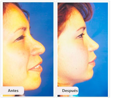 Rinoplastía Secundaria: Caso 1