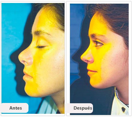 Rinoplastía Secundaria: Caso 2