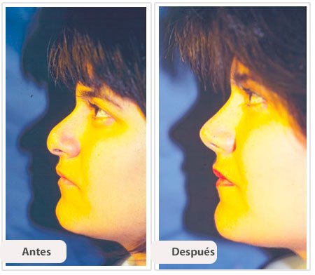 Rinoplastía Secundaria: Caso 3