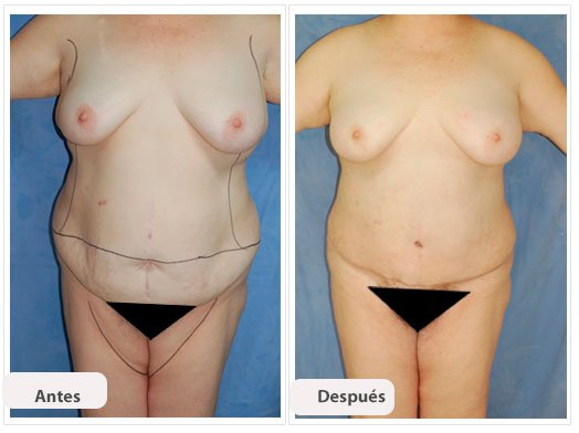 Abdominoplastia Caso 4: vista de frente