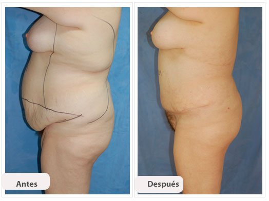 Abdominoplastia Caso 4: vista de perfil