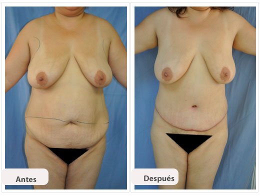 Abdominoplastia Caso 5: vista de frente