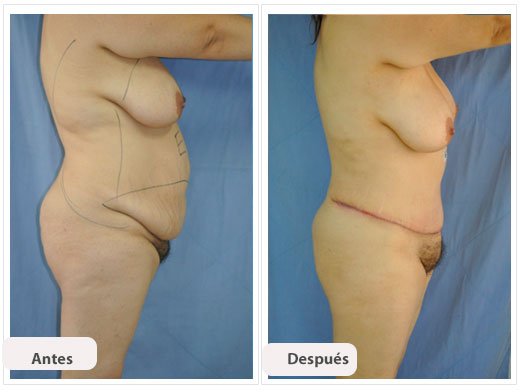 Abdominoplastia Caso 5: vista de perfil