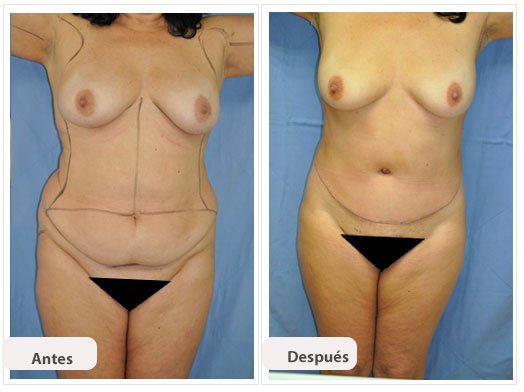 Abdominoplastia Caso 1: vista de frente