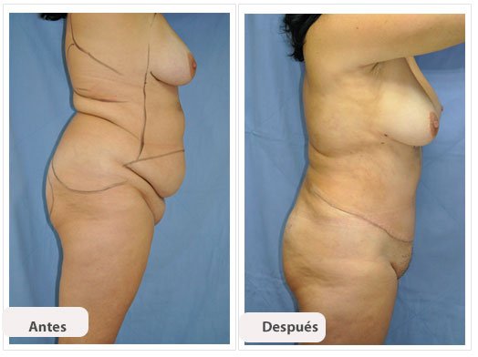 Abdominoplastia Caso 1: vista de perfil