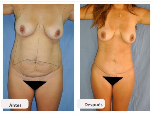 Abdominoplastia Caso 2: vista de frente