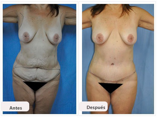 Abdominoplastia Caso 3: vista de frente
