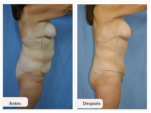 Abdominoplastia Caso 3: vista de perfil