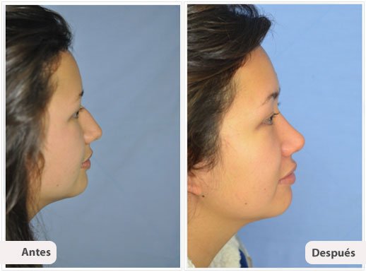 Rinoplastía Primaria: Perfil Caso 6