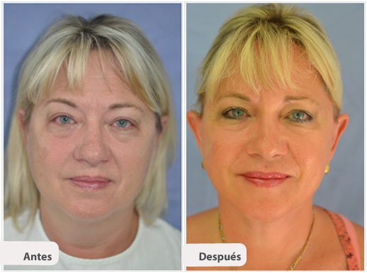 Ritidectomía: Caso 1