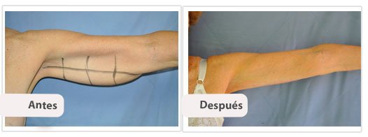 Braquioplastía Longitudinal: Caso 1