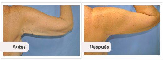 Braquioplastia Axilar: Caso 1