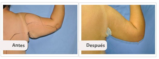 Braquioplastia Axilar: Caso 2