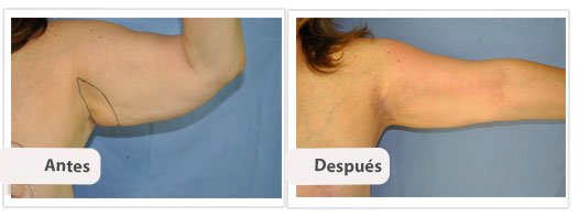 Braquioplastia Axilar: Caso 3