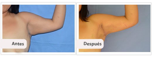 Braquioplastia Axilar: Caso 4