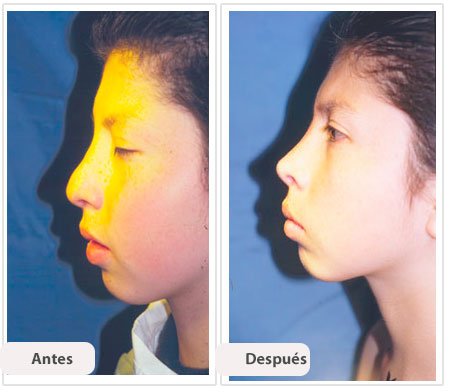 Rinoplastía Secundaria: Caso 4