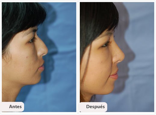 Rinoplastía Primaria: Caso 2