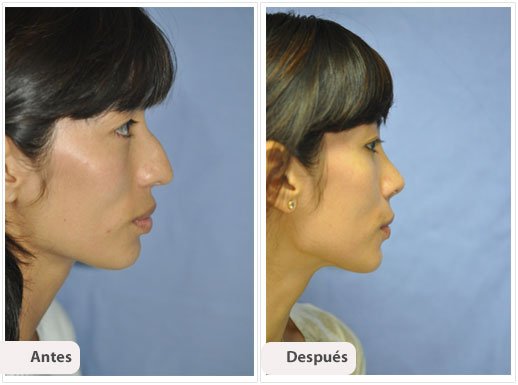 Rinoplastía Primaria: Perfil Caso 4