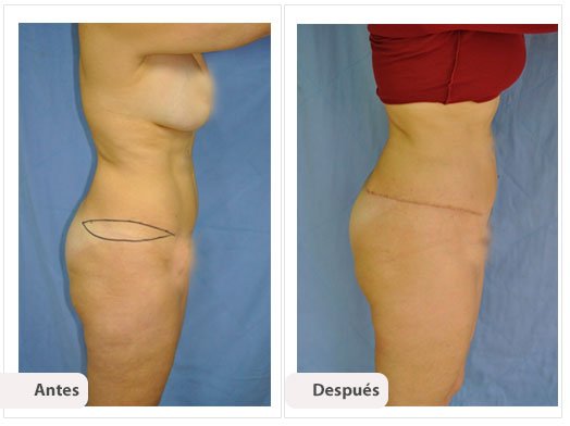 Lifting de Muslo Externos: Caso 1