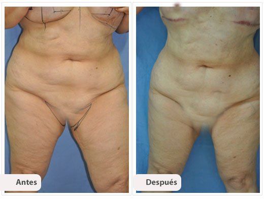 Lifting de Muslos Internos: Caso 1