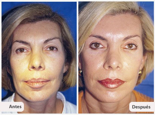 Ritidectomía: Caso 2