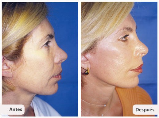 Ritidectomía: Perfil Caso 2