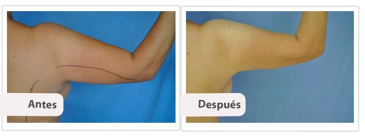 Liposucción de Brazos: Caso 3