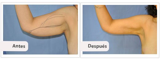 Liposucción de Brazos: Caso 4