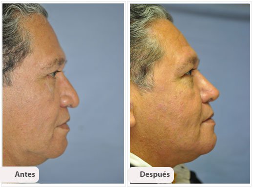 Rinoplastía Primaria: Perfil Caso 5
