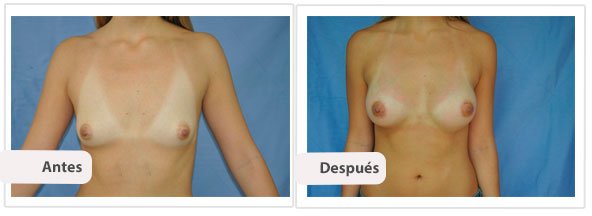 Caso 1 TAMAÑO: 275 cc