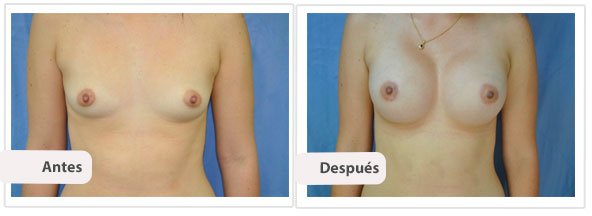 Caso 14 TAMAÑO: 400 cc