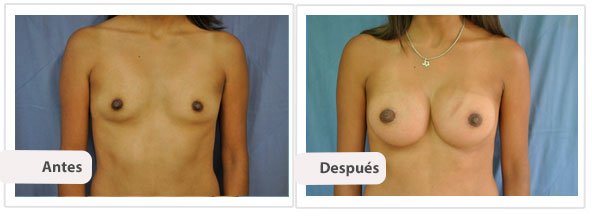 Caso 10 TAMAÑO: 350 cc