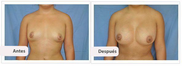 Caso 11 TAMAÑO: 375 cc