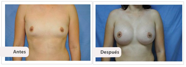 Caso 13 TAMAÑO: 400 cc