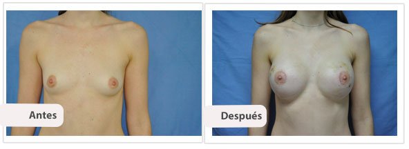 Caso 12 TAMAÑO: 400 cc