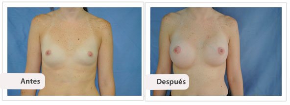 Caso 2 TAMAÑO: 275 cc